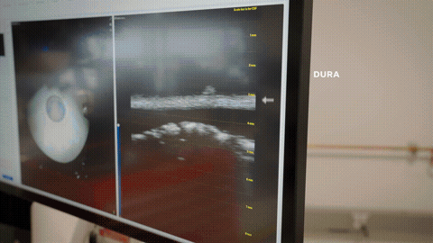 Animation: live aufgebaute optische Tiefenmessung der Schichten Dura, Subarachnoidalraum und Hirnrinde