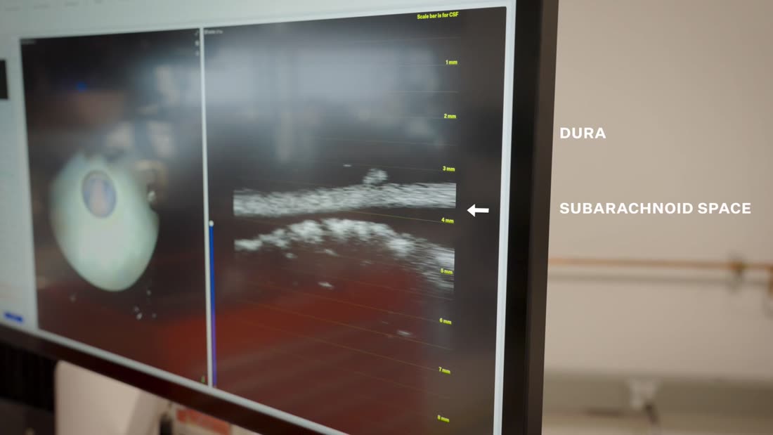 Monitor im Labor mit Live-Messung, beschriftet mit Dura und Subarachnoidalraum