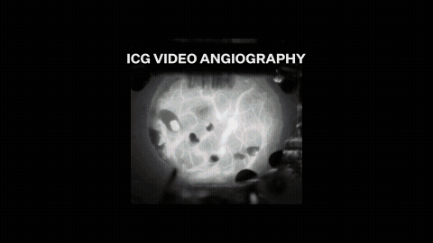 Animation: Blutgefäße werden per ICG-Fluoreszenz unter der Hirnhaut sichtbar und glühen hell auf